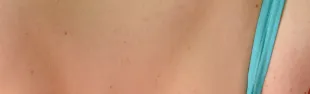 Controllo nevi